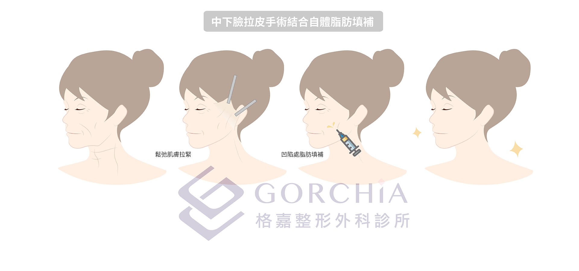 中下臉拉皮結合自體脂肪填補